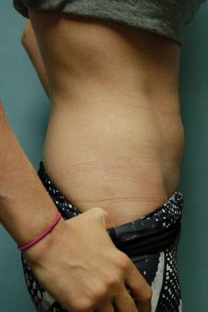 SculpSure™ Fat Removal Case 4619 Before Photo SculpSure™ Fat Removal