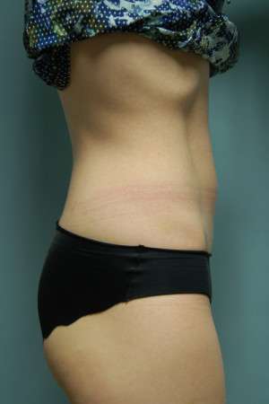 SculpSure™ Fat Removal Case 4619 After Photo SculpSure™ Fat Removal