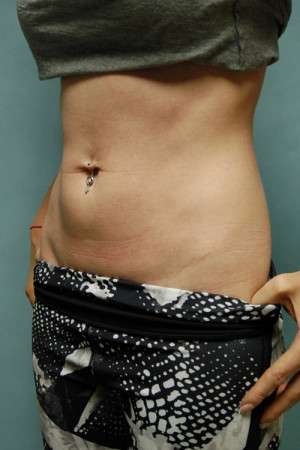 SculpSure™ Fat Removal Case 4619 Before Photo SculpSure™ Fat Removal