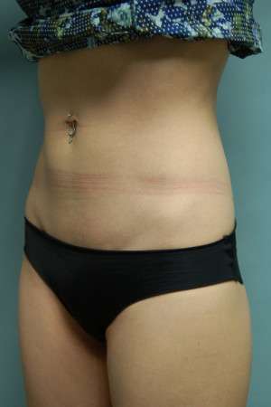 SculpSure™ Fat Removal Case 4619 After Photo SculpSure™ Fat Removal