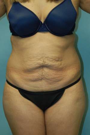 Abdominoplasty