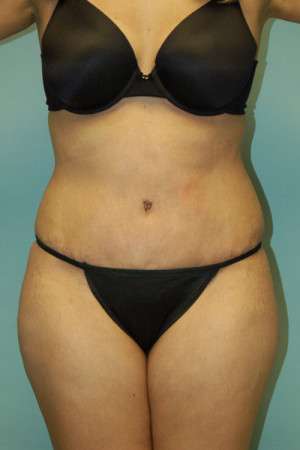 Abdominoplasty