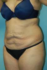 Abdominoplasty