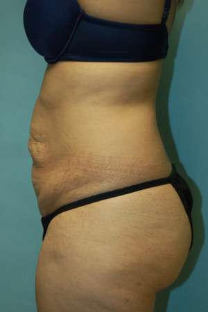 Abdominoplasty