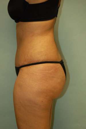 Abdominoplasty