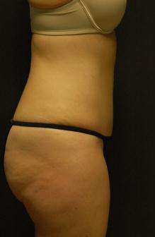 Abdominoplasty