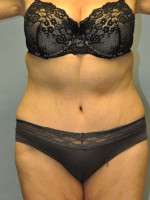 Abdominoplasty