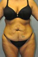 Abdominoplasty