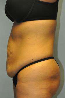 Abdominoplasty Case 4867 Before Photo Abdominoplasty