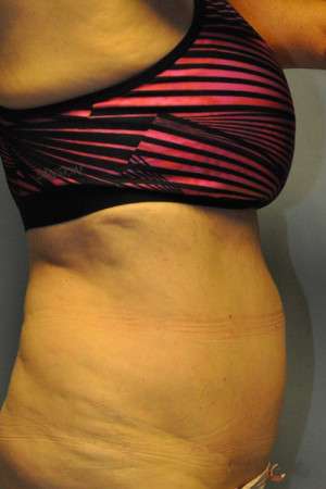 SculpSure™ Fat Removal Case 4896 After Photo SculpSure™ Fat Removal