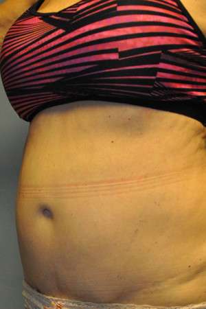 SculpSure™ Fat Removal Case 4896 After Photo SculpSure™ Fat Removal