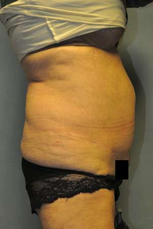 SculpSure™ Fat Removal Case 4896 Before Photo SculpSure™ Fat Removal