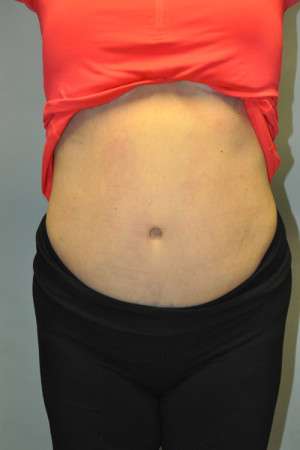 SculpSure™ Fat Removal Case 4896 After Photo SculpSure™ Fat Removal