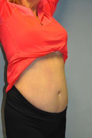 SculpSure™ Fat Removal Case 4896 After Photo SculpSure™ Fat Removal