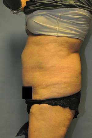 SculpSure™ Fat Removal Case 4896 Before Photo SculpSure™ Fat Removal