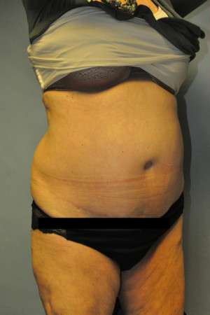 SculpSure™ Fat Removal Case 4896 Before Photo SculpSure™ Fat Removal