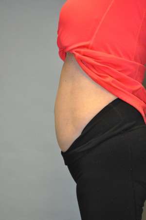 SculpSure™ Fat Removal Case 4896 After Photo SculpSure™ Fat Removal