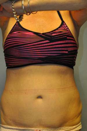 SculpSure™ Fat Removal Case 4896 After Photo SculpSure™ Fat Removal