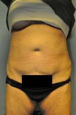 SculpSure™ Fat Removal