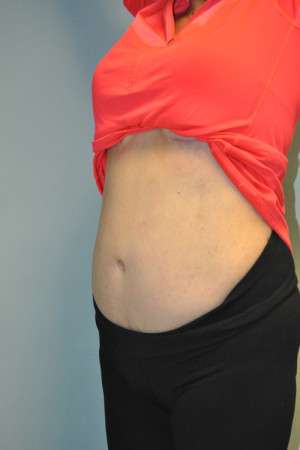SculpSure™ Fat Removal Case 4896 After Photo SculpSure™ Fat Removal