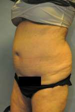 SculpSure™ Fat Removal