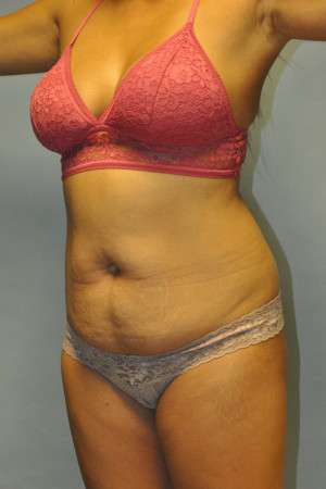 Abdominoplasty Case 4998 Before Photo Abdominoplasty