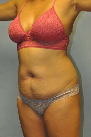 Abdominoplasty