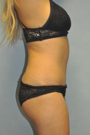 Abdominoplasty