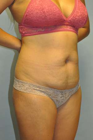 Abdominoplasty Case 4998 Before Photo Abdominoplasty