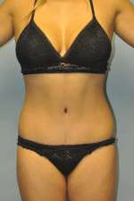 Abdominoplasty