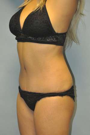 Abdominoplasty Case 4998 After Photo Abdominoplasty