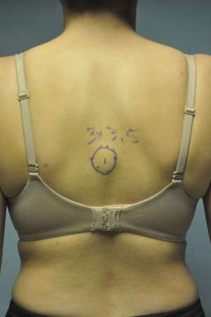 Minimal Incision and Power-assisted Liposuction Removal of Lipomas Case 5028 Before Photo Minimal Incision and Power-assisted Liposuction Removal of Lipomas