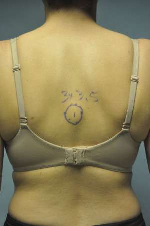 Minimal Incision and Power-assisted Liposuction Removal of Lipomas