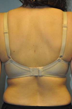 Minimal Incision and Power-assisted Liposuction Removal of Lipomas Case 5028 After Photo Minimal Incision and Power-assisted Liposuction Removal of Lipomas