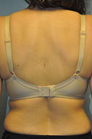 Minimal Incision and Power-assisted Liposuction Removal of Lipomas