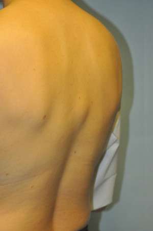 Minimal Incision and Power-assisted Liposuction Removal of Lipomas Case 5028 Before Photo Minimal Incision and Power-assisted Liposuction Removal of Lipomas