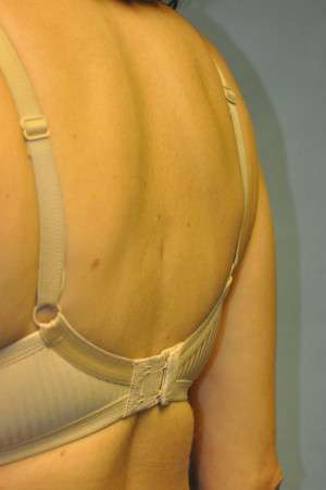Minimal Incision and Power-assisted Liposuction Removal of Lipomas Case 5028 After Photo Minimal Incision and Power-assisted Liposuction Removal of Lipomas