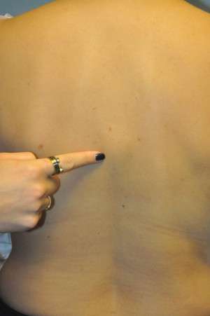 Minimal Incision and Power-assisted Liposuction Removal of Lipomas Case 5028 Before Photo Minimal Incision and Power-assisted Liposuction Removal of Lipomas