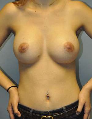 Breast Augmentation, Gel Case 5016 After Photo Breast Augmentation, Gel
