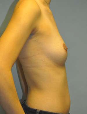 Breast Augmentation, Gel Case 5016 Before Photo Breast Augmentation, Gel