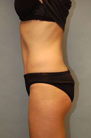 Abdominoplasty Case 5187 After Photo Abdominoplasty