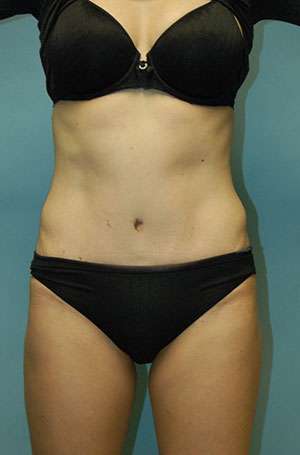 Abdominoplasty Case 5187 After Photo Abdominoplasty
