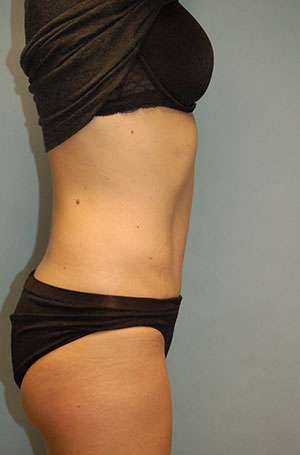 Abdominoplasty Case 5187 After Photo Abdominoplasty