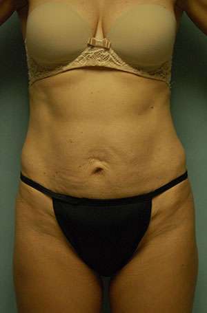 Abdominoplasty