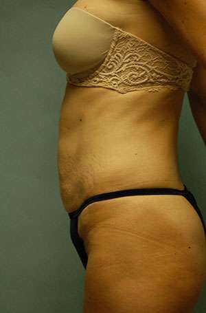 Abdominoplasty Case 5187 Before Photo Abdominoplasty