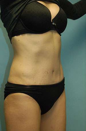 Abdominoplasty