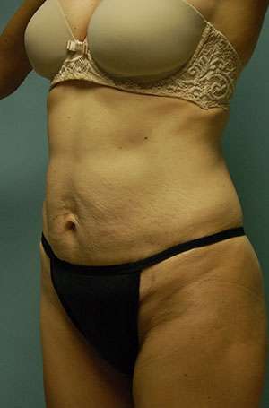 Abdominoplasty Case 5187 Before Photo Abdominoplasty