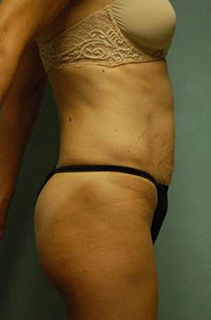 Abdominoplasty Case 5187 Before Photo Abdominoplasty