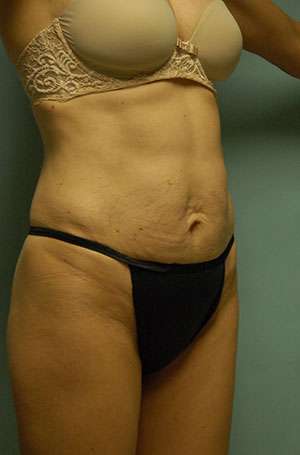 Abdominoplasty