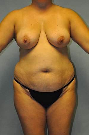 Abdominoplasty Case 5199 Before Photo Abdominoplasty